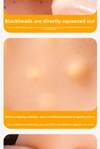 Stress Relief Artifact Pimple Squeezing Toy Big Head Blackhead Acne Nose Simulation Model Stress Relief Doll Toy