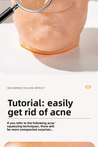 Stress Relief Artifact Pimple Squeezing Toy Big Head Blackhead Acne Nose Simulation Model Stress Relief Doll Toy
